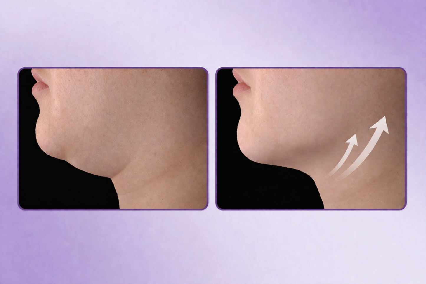 LumiLift – At-Home Skin Tightening Device