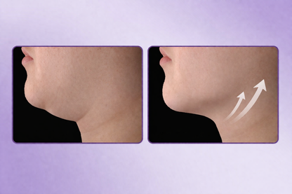 LumiLift – At-Home Skin Tightening Device