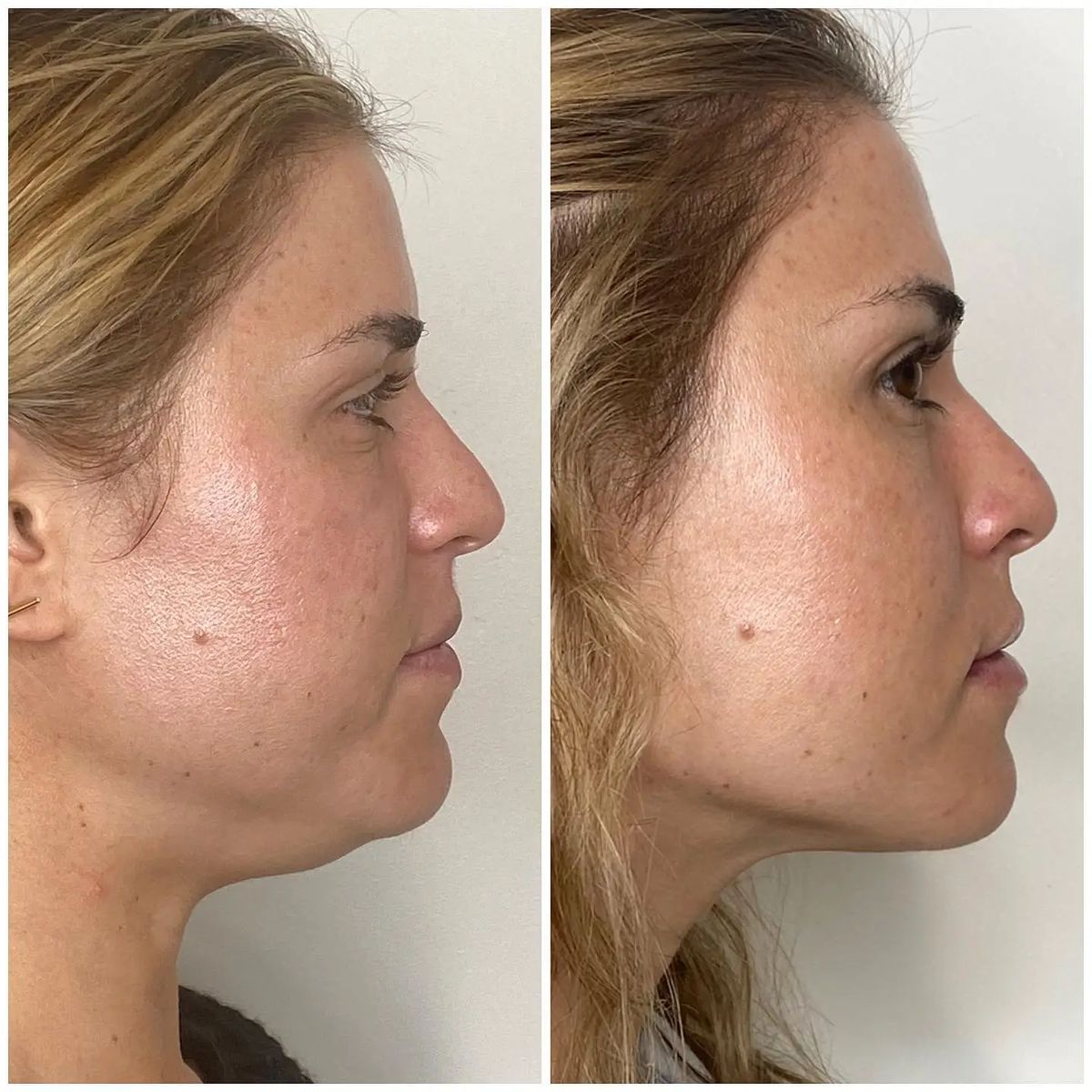 LumiLift – At-Home Skin Tightening Device