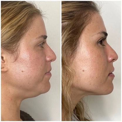 LumiLift – At-Home Skin Tightening Device
