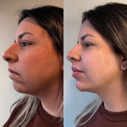 LumiLift – At-Home Skin Tightening Device